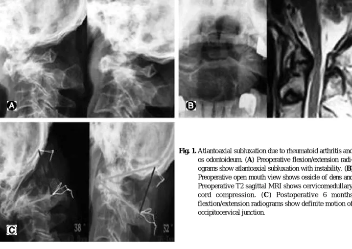 Fig. 1. Atlantoaxial subluxation due to rheumatoid arthritis and os odontoideum. (A) Preoperative flexion/extension  radi-ograms show atlantoaxial subluxation with instability