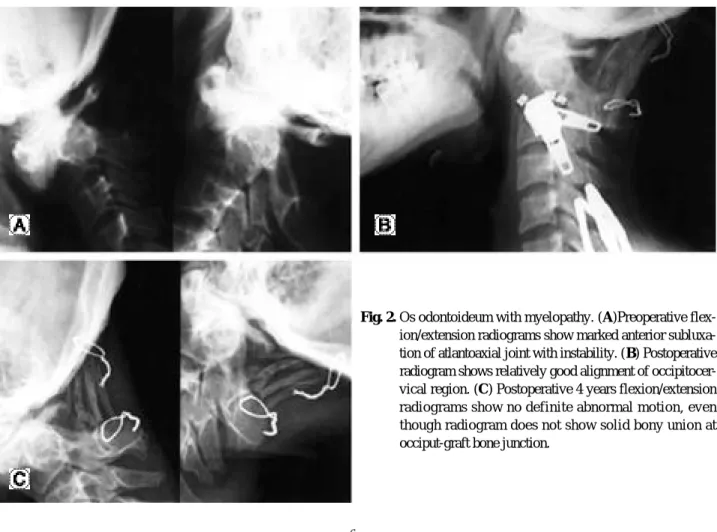 Fig. 2. Os odontoideum with myelopathy. (A)Preoperative flex- flex-ion/extension radiograms show marked anterior  subluxa-tion of atlantoaxial joint with instability