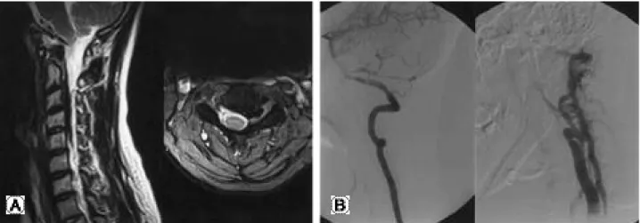 Fig. 1. (A) Pre-embolization MRI at C3-4 level. The cervical dura is compressed by dilated, engorged epidural veins and feeding artery is located in the left C 3-4 intervertebral foramen