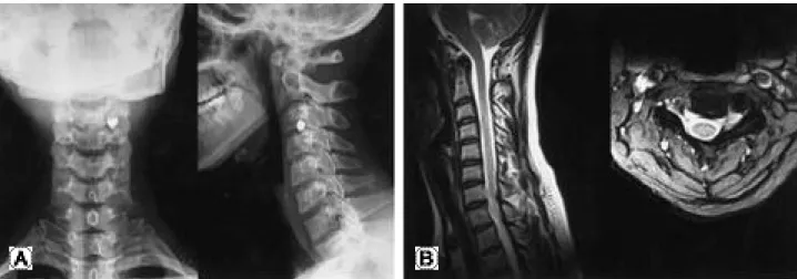 Fig. 4. (A) Postoperative cervical radiogram. (B) Postoperative cervical spine MRIs show the complete loss of the extradural arteri- arteri-ovenous fistula.