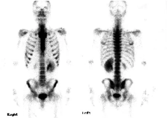 Fig. 2. Preoperative bone scan showing tear drop shaped increased uptake of upper thoracic spine from T1 to T4.