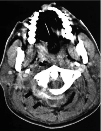 Fig. 2. Initial MRI (enhanced axial T1 weighted) shows paraspinal abscess around C1-2 level (arrows)