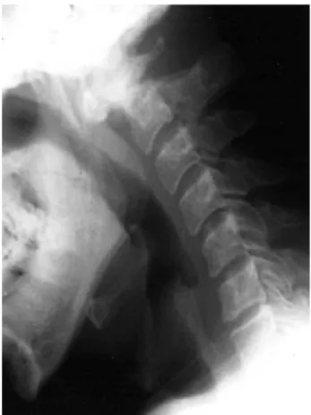 Fig. 3. Lateral radiograph of neck taken at 3 months after open drainage shows normal bony structure.