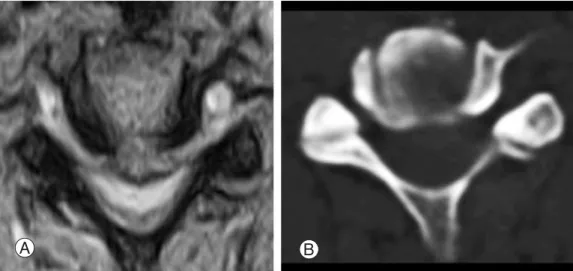 Fig. 1. cervical myelopathy due to soft disc on axial view of T2 WI MRI and CT.