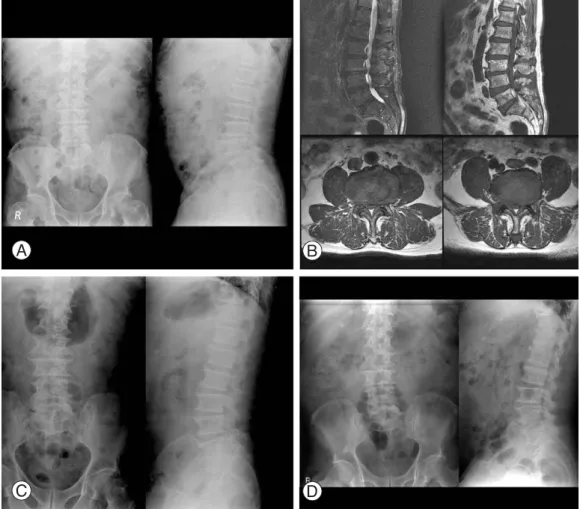 Fig. 1. (A) A 79 years old man sustained both lower leg pain 3 month ago. Initial radiograph showed general osteophytes and forami- forami-nal narrowing on L1-S1