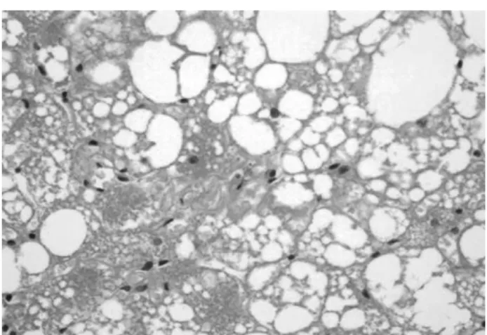 Fig. 6. Histologically, the mass showed a mixture of brown and white adipose cells and was divided into lobules by well vascularized connective tissue