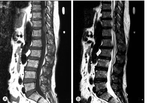 Fig. 1. (A)T1 weighted sagittal image shows epidural masses at T10, T11, T12 level that have homogenous intermediate signal inten- inten-sity representing acute hematoma