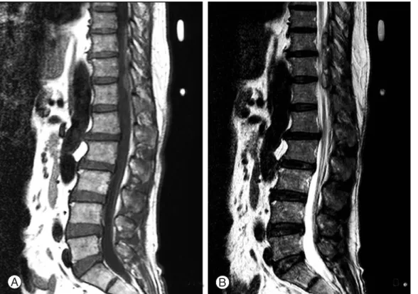 Fig. 1. (A)T1 weighted sagittal image shows epidural masses at T10, T11, T12 level that have homogenous intermediate signal inten- inten-sity representing acute hematoma