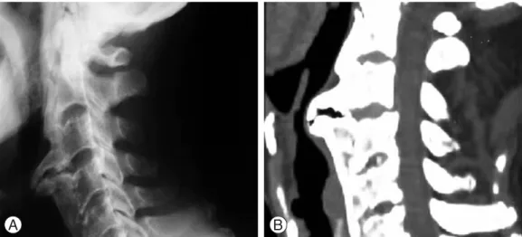 Fig. 1. (A) and (B) Preoperative cervical spine lateral radiograph and sagittal CT scan show contiguous ossification along the anterior aspect of the first (C1) to seventh cervical vertebrae (C7), with a localized osteophyte between C3 and C4