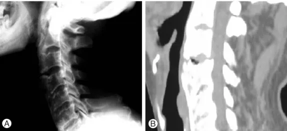 Fig. 3. (A) and (B) Postoperative cervical spine lateral radiograph and sagittal CT scan show no osteophytes between C3 and C4.