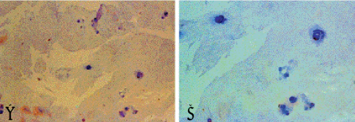 Fig. 1. (A, B) Photomicrographs of immunohistochemical staining for MMP-3(counter-stain with H-E,  ×100, ×400)