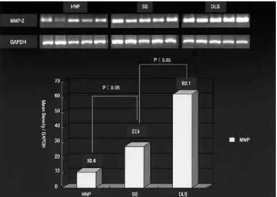 Fig. 6. RT-PCR amplication of MMP-3 mRNA in the human intervertebral disc which are excised from DLS, SS and HNP
