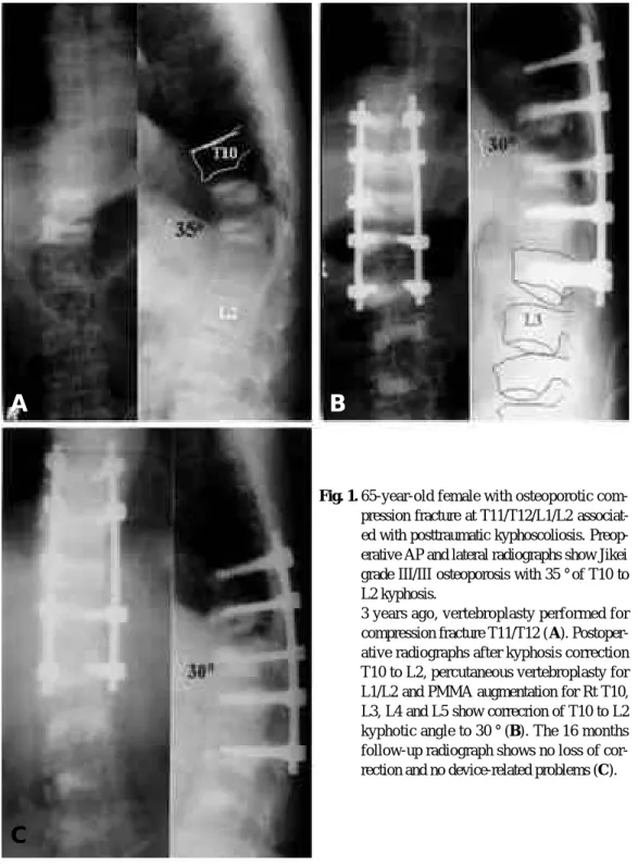 Fig. 1. 65-year-old female with osteoporotic com- com-pression fracture at T11/T12/L1/L2  associat-ed with posttraumatic kyphoscoliosis