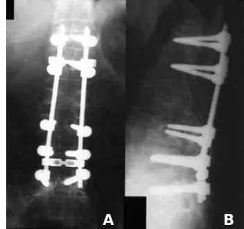 Fig. 4. At 30 months postoperatively, the operated site is main- main-tained well. It is not easy to define the degree of bony fusion