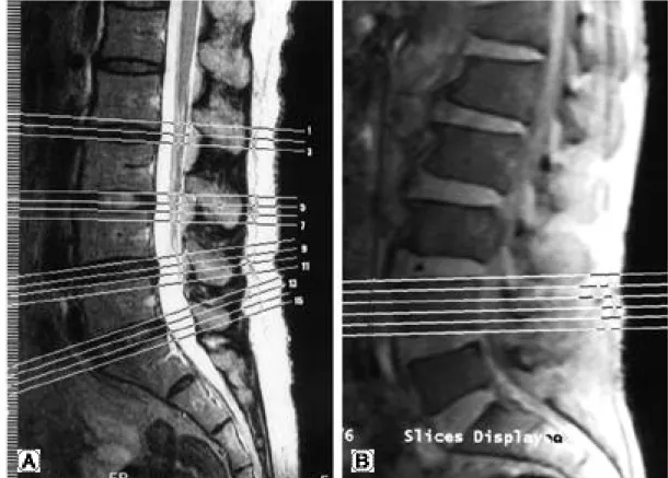 Fig. 1. (A) Scout film of routine axial image (B) Scout film of body-cut axial image