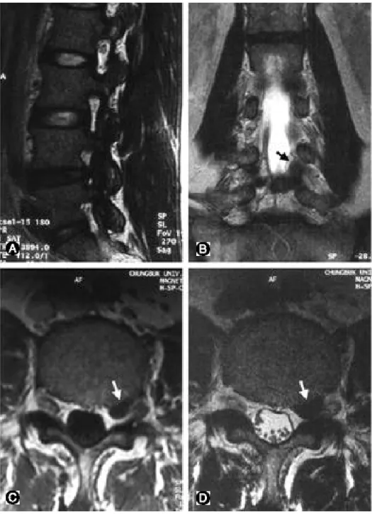 Fig. 2. A 59 year-old man with severe radiating pain on left lower extremity. (A) T2 sagittal image shows protrusion of L4-5 disc, which usually suggests compression of L5 root