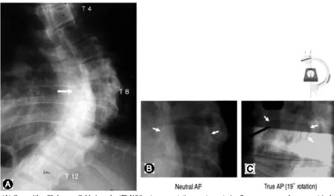 Fig. 2. (A) Case with a 69 degrees Cobb ’ s angle. (B) Without c-arm rotation, posteroanterior fluoroscopy reveals asymmetrical visu- visu-alization of both pedicles with a Nash-Moe grade II deformity