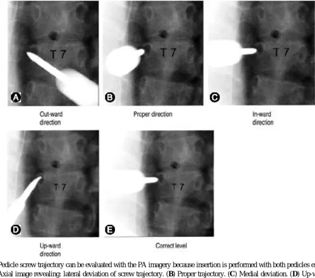 Fig. 3. Pedicle screw trajectory can be evaluated with the PA imagery because insertion is performed with both pedicles en face
