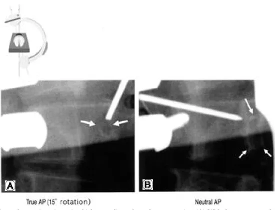Fig. 4. Comparison of screw insertion using biplanar radiographs and c-arm rotation. (A) With the c-arm rotated 15 degrees, both pedicles are symmetrical and a K-wire is inserted into the right pedicle at 2 o’ clock