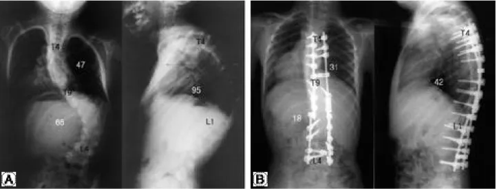 Fig. 6. A 17 kg kyphosis patient using the rotating posteroanterior c-arm fluoroscopic guidance technique