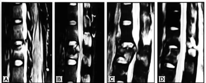 Fig. 2. State of the ligamentous structures observed on the MRI examinations. (A) No evidence of injury