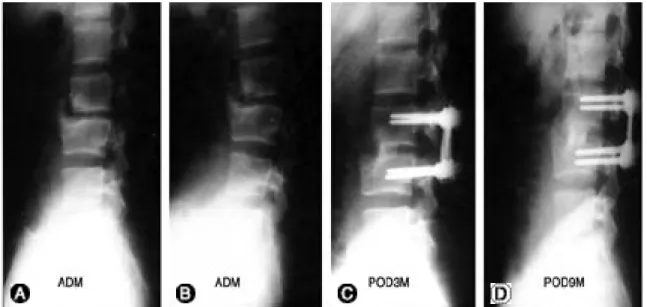 Fig. 3. (A,  B) This 18 year old male had back pain and limit of spinal motion due to segmental instability