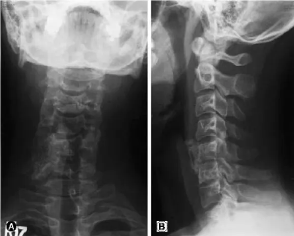 Fig. 1. It shows amorphous bony mass contained irregular bony trabeculae in right lateral portion of the 5-6 cervical spine on plain X-ray anteroposterior view and lateral view.