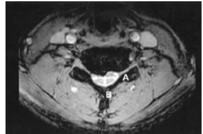 Fig. 1. Transverse area of the spinal cord. Fig. 2. Compression ratio = [sagittal diameter (B) / transverse diameter(A)] ×100(%).
