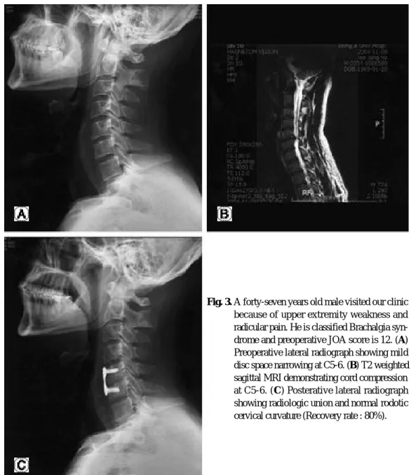 Fig. 3. A forty-seven years old male visited our clinic because of upper extremity weakness and radicular pain