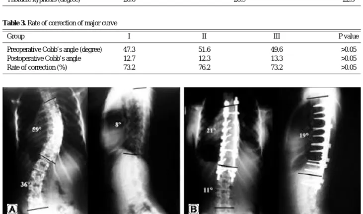 Table 1. Preoperative coronal angle, flexibility and thoracic kyphosis