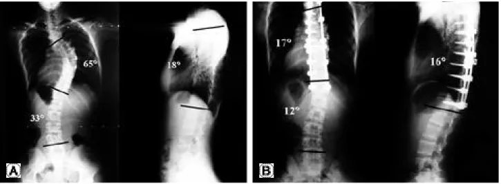 Fig. 3. (A) In group III (XIA instrumentation), Preoperative major thoracic curve was 65°and kyphotic angle was 18°