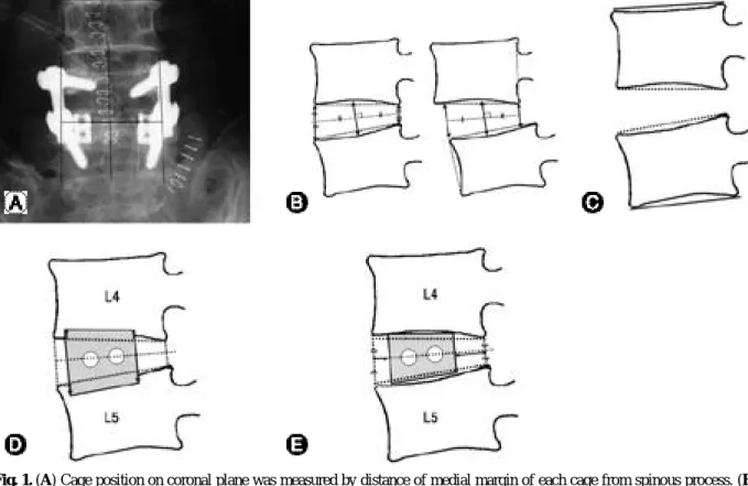 Fig. 1. (A) Cage position on coronal plane was measured by distance of medial margin of each cage from spinous process