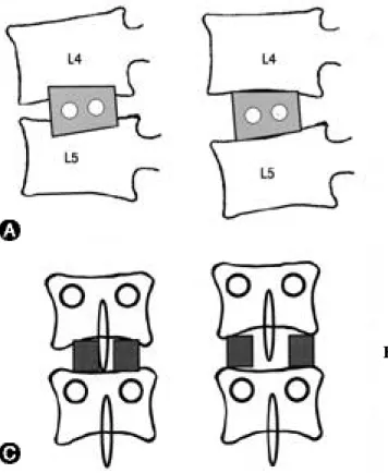 Fig. 4. (A) The cage invagination into end plate would decrease the amount of segmental lordosis angle restoration
