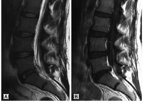 Fig. 2. (A) Axial T2-weighted magnetic resonance image shows that dura sac is compressed by hernaiated disc material at L5-S1 (B) Axial enhanced T1-weighted magnetic resonance image shows rim enhanced disc material at L5-S1.