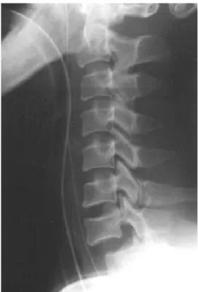 Fig. 3. Radiograph of Posttranspedicular fixation of C7-T2 shows satisfactory reduction and alignment