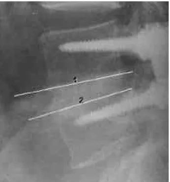 Fig. 1. Lordotic angle measures the angle between the lower end plate of the upper lumbar body and upper end plate of the lower lumbar body, which underwent fusion.