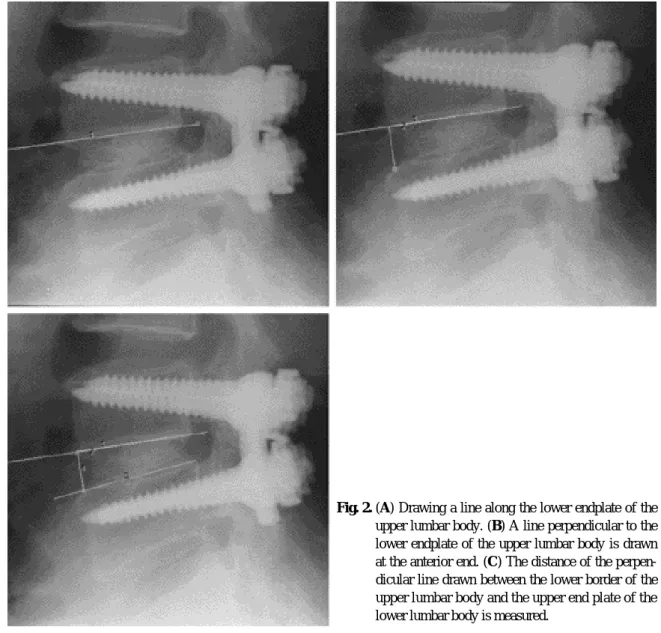 Fig. 2. (A) Drawing a line along the lower endplate of the upper lumbar body. (B) A line perpendicular to the lower endplate of the upper lumbar body is drawn at the anterior end