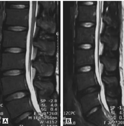 Fig. 2. (A) A 22-year-old man with mild bulging of L4-5 and Thompson grade was grade II