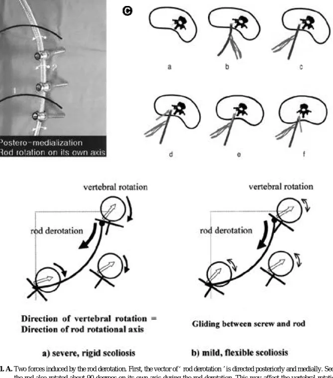 Fig. 1. A. Two forces induced by the rod derotation. First, the vector of  ‘rod derotation’is directed posteriorly and medially