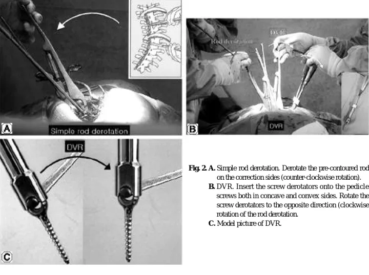 Fig. 2. A. Simple rod derotation. Derotate the pre-contoured rod on the correction sides (counter-clockwise rotation)