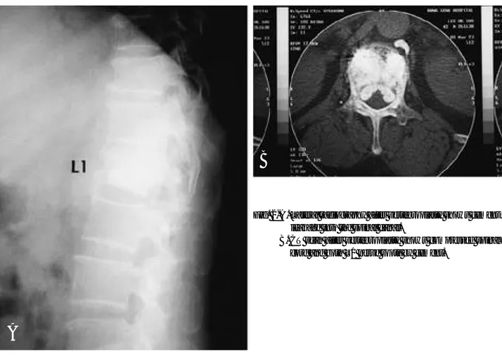 Fig. 1-B. CT scan after vertebroplasty shows compressed spinal cord and both L1 nerve roots by cement.