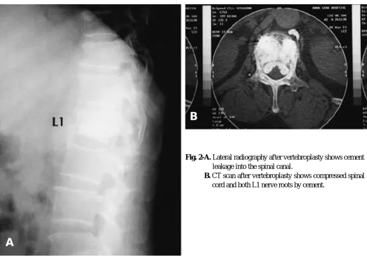 Fig. 1-B. CT scan after vertebroplasty shows compressed spinal cord and both L1 nerve roots by cement.