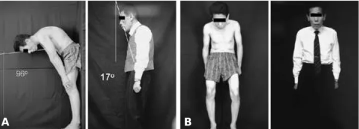 Fig. 3. Clinical photo of a 37-year old patient. A. Preoperative chin brow vertical angle was 17 degrees and postoperative chin brow vertical angle was -13 degrees