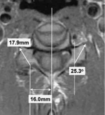 Fig. 2. Ideal entry points, insertion angle and length of the lat- lat-eral mass for latlat-eral mass screw fixation were measured on the axial MR images using PACS digital measuring i n s t r u m e n t .