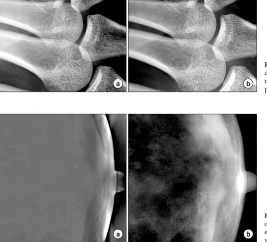 Fig.  6.  Comparative  view  of  result  on  mammographic  image   process-ed  by  conventional  method  using  wavelet  (a)  and  proposed  method.