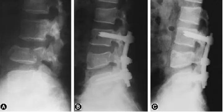 Fig. 1-B : Immediate postoperative radiograph, treated posterolateral fusion with above and below 1 level fixation, shows satisfactory reduction.