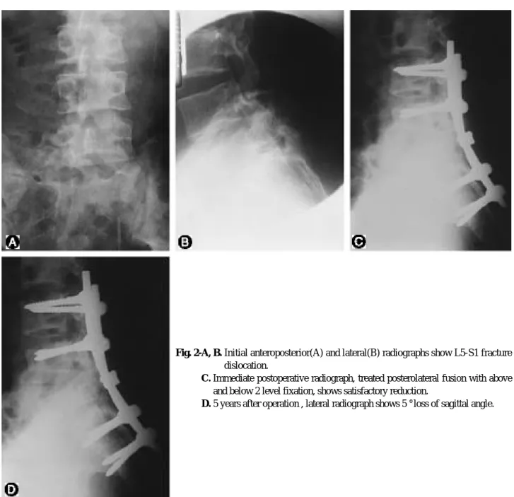 Fig. 2-C. Immediate postoperative radiograph, treated posterolateral fusion with above and below 2 level fixation, shows satisfactory reduction.