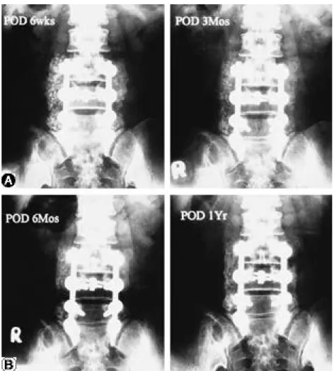 Table 1. Radiographic fusion grading of local bone and auto- auto-genous iliac bone