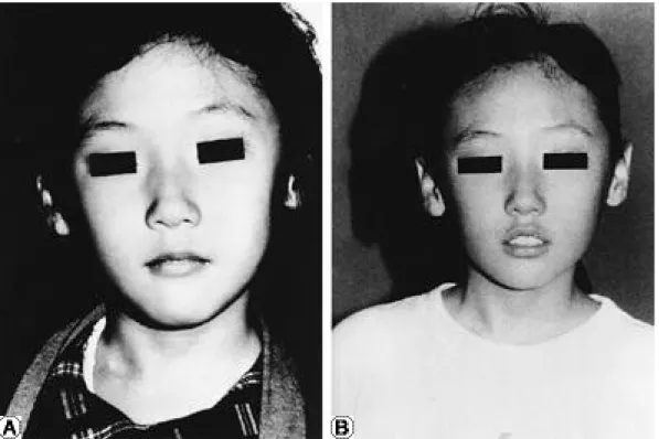 Fig. 1. Preoperative photograph of a 8-year-old girl with the congenital muscular torticollis on the right side showed moderate degree of facial asymmetry and head tilt A