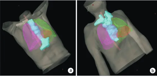 Fig. 1. Examples of a long, tube- tube-shaped planning target volume (PTV)  of esophageal cancer surrounding  cri  ti cal organs at risk such as left and  right lungs, heart, and spinal cord  for pa tients #1 (a) and #3 (b)